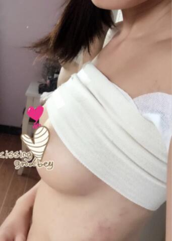 假體隆胸果自然嗎 假體隆胸親身經(jīng)歷