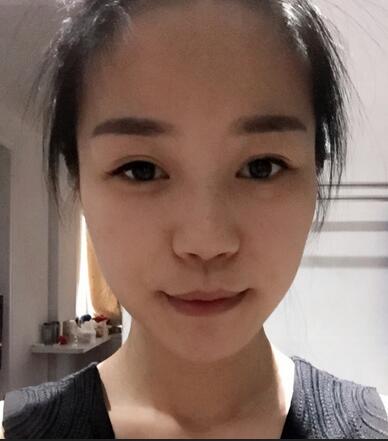 硅膠隆鼻前后對(duì)比 硅膠隆鼻+鼻小柱延長恢復(fù)日記