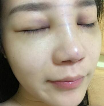 硅膠隆鼻前后對(duì)比 硅膠隆鼻+鼻小柱延長恢復(fù)日記