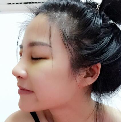 硅膠隆鼻前后對(duì)比 硅膠隆鼻+鼻小柱延長恢復(fù)日記