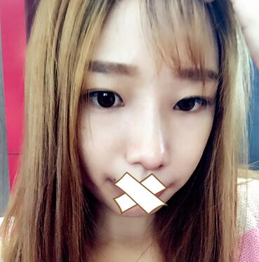 硅膠隆鼻恢復(fù)日記 硅膠隆鼻+鼻小柱延長(zhǎng)+墊鼻尖