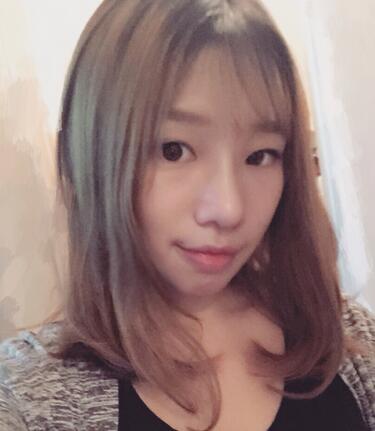 硅膠隆鼻恢復(fù)日記 硅膠隆鼻+鼻小柱延長(zhǎng)+墊鼻尖