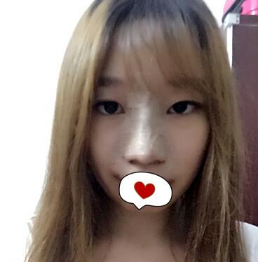 硅膠隆鼻恢復(fù)日記 硅膠隆鼻+鼻小柱延長(zhǎng)+墊鼻尖