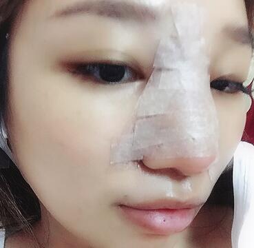 硅膠隆鼻恢復(fù)日記 硅膠隆鼻+鼻小柱延長(zhǎng)+墊鼻尖