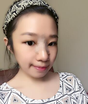 硅膠隆鼻恢復(fù)日記 硅膠隆鼻+鼻小柱延長(zhǎng)+墊鼻尖