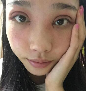 全割雙眼皮恢復日記 全切雙眼皮+開眼角