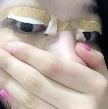 全割雙眼皮恢復日記 全切雙眼皮+開眼角