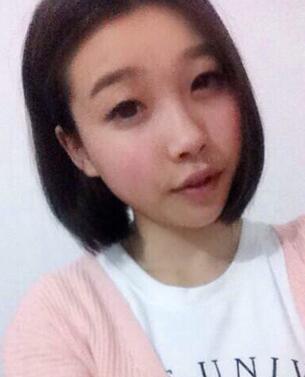 全割雙眼皮恢復日記 全切雙眼皮+開眼角