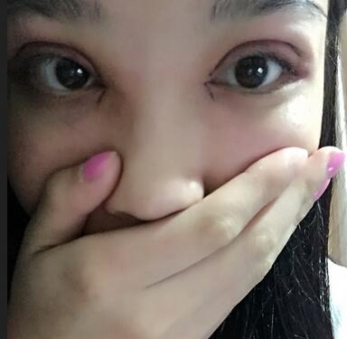 全割雙眼皮恢復日記 全切雙眼皮+開眼角