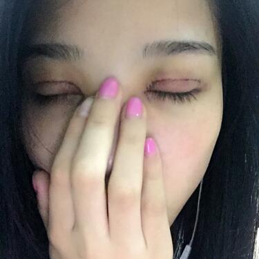 全割雙眼皮恢復日記 全切雙眼皮+開眼角