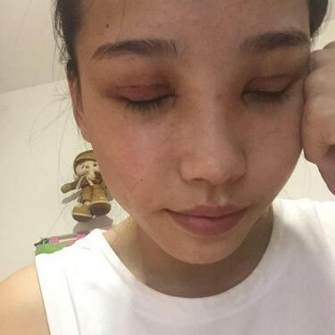 全割雙眼皮恢復日記 全切雙眼皮+開眼角