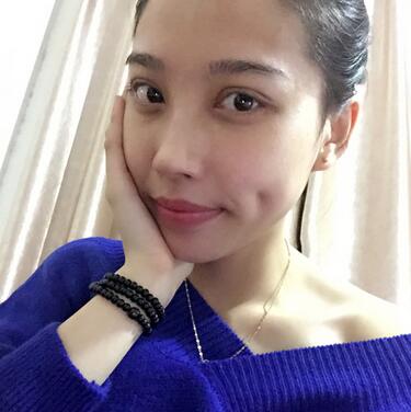 全割雙眼皮恢復日記 全切雙眼皮+開眼角