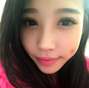 全割雙眼皮恢復日記 全切雙眼皮+開眼角