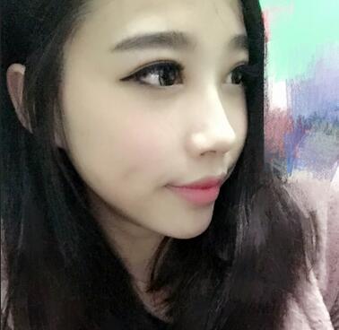 全割雙眼皮恢復日記 全切雙眼皮+開眼角