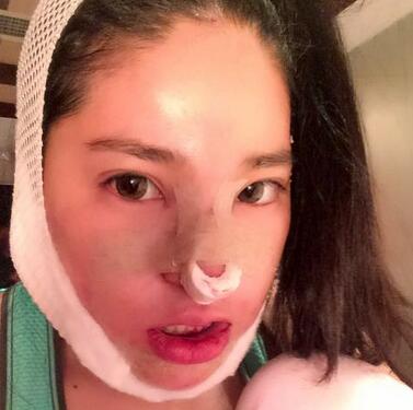 隆鼻整形2個月恢復日記 硅膠隆鼻+鼻翼縮小