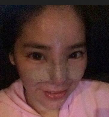 隆鼻整形2個月恢復日記 硅膠隆鼻+鼻翼縮小