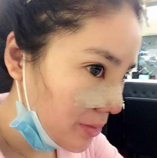 隆鼻整形2個月恢復日記 硅膠隆鼻+鼻翼縮小