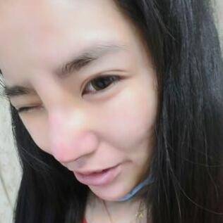 隆鼻整形2個月恢復日記 硅膠隆鼻+鼻翼縮小