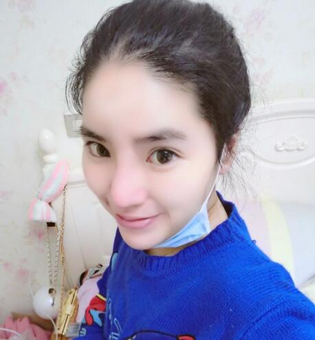 隆鼻整形2個月恢復日記 硅膠隆鼻+鼻翼縮小