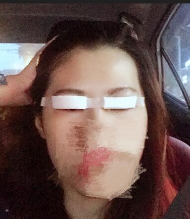 切開重瞼術(shù)恢復(fù)過程圖