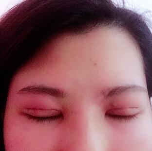 切開重瞼術(shù)恢復(fù)過程圖