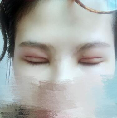 切開重瞼術(shù)恢復(fù)過程圖