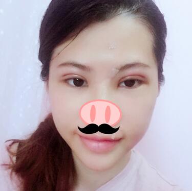 切開重瞼術(shù)恢復(fù)過程圖