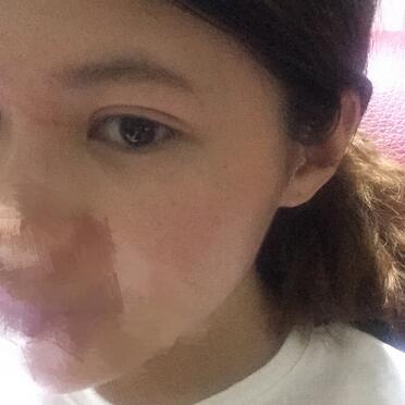 切開重瞼術(shù)恢復(fù)過程圖