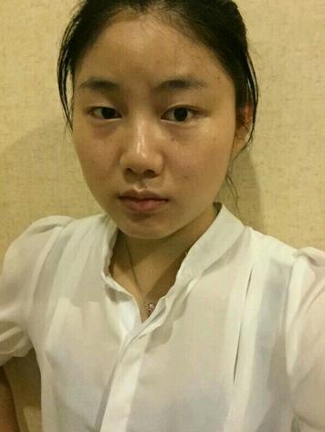 全切雙眼皮半年恢復過程圖