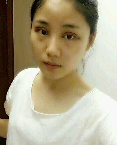 全切雙眼皮半年恢復過程圖