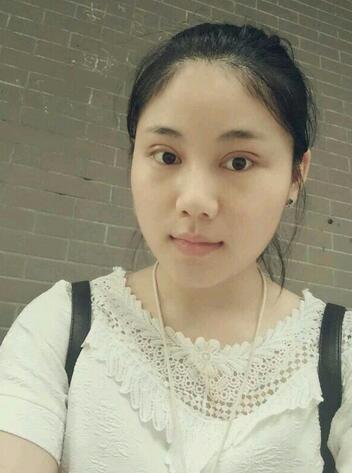 全切雙眼皮半年恢復過程圖