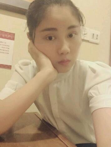 全切雙眼皮半年恢復過程圖