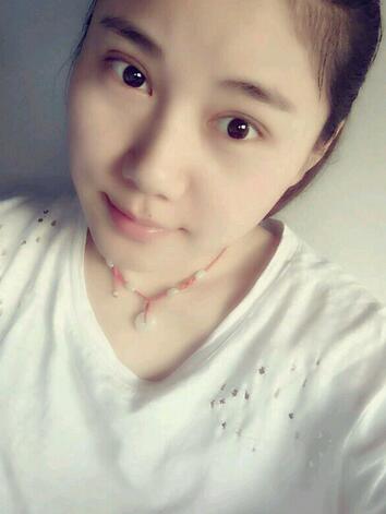 全切雙眼皮半年恢復過程圖