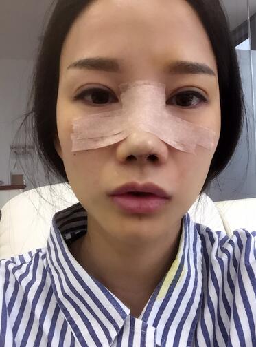 隆鼻整形真實恢經(jīng)歷 曬圖啦!