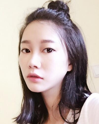 隆鼻整形真實恢經(jīng)歷 曬圖啦!