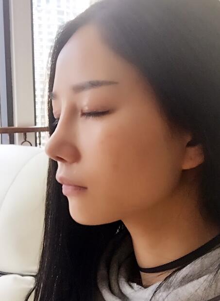 隆鼻整形真實恢經(jīng)歷 曬圖啦!