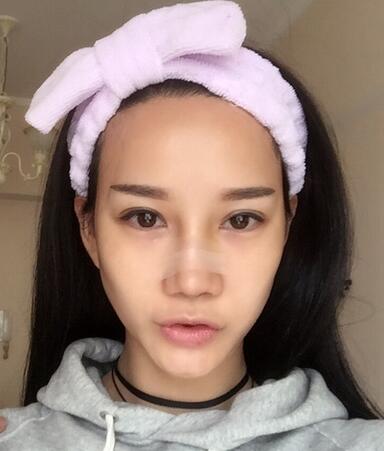 隆鼻整形真實恢經(jīng)歷 曬圖啦!