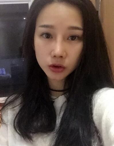 隆鼻整形真實恢經(jīng)歷 曬圖啦!