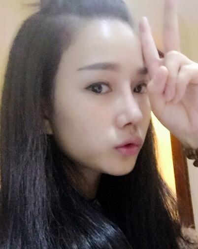 隆鼻整形真實恢經(jīng)歷 曬圖啦!