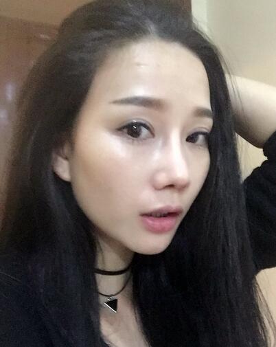 隆鼻整形真實恢經(jīng)歷 曬圖啦!