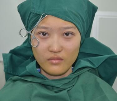 切開雙眼皮恢復(fù)全過程