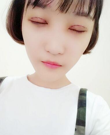切開雙眼皮恢復(fù)全過程
