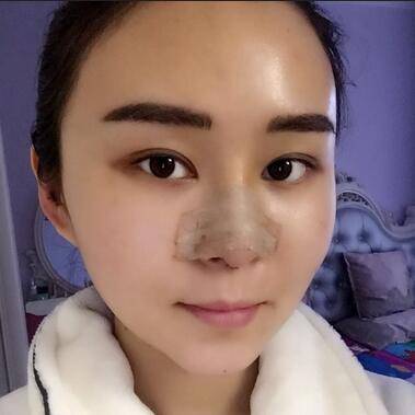 上海余天成二次鼻修復(fù)恢復(fù)日記 隆鼻整形修復(fù)+下巴吸脂