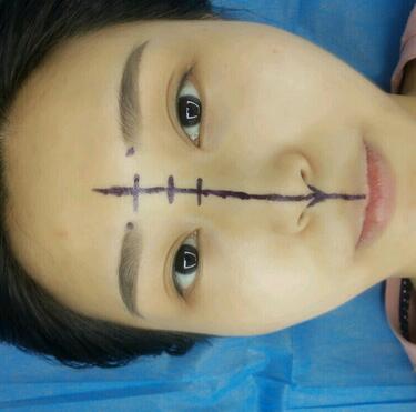 上海澳雅鼻小柱鼻中隔延長+耳軟骨鼻尖2個(gè)月的照片