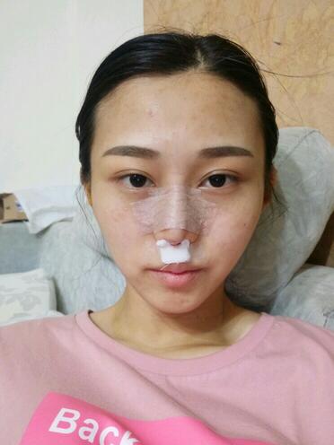 上海澳雅鼻小柱鼻中隔延長+耳軟骨鼻尖2個(gè)月的照片