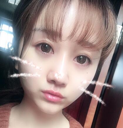 上海潔銘線D提升三個(gè)月后的圖片