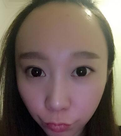 廣州倍生女性發(fā)際線(xiàn)調(diào)整案例