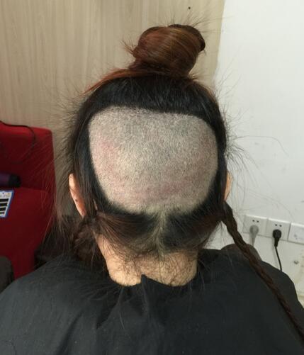 廣州倍生女性發(fā)際線(xiàn)調(diào)整案例