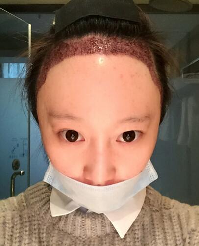 廣州倍生女性發(fā)際線(xiàn)調(diào)整案例