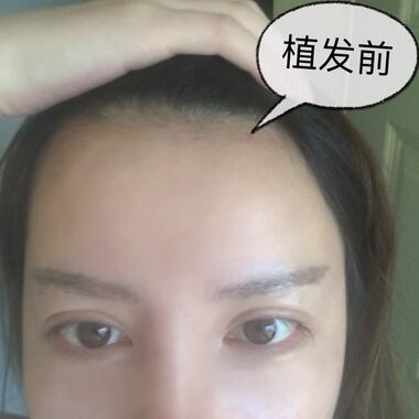廣州倍生發(fā)際線(xiàn)種植前后對(duì)比照片
